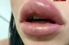 Wanita ini Hampir Buta Seketika Akibat Filler Bibir-nya Pecah