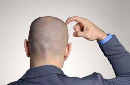 Polusi Udara Ternyata Bisa Picu Kebotakan