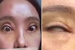 Ingin Punya Mata yang Lebar, Kelopak Mata Wanita Tiongkok Ini Justru Tak Bisa Menutup