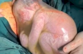 Foto Menakjubkan: Bayi ini Dilahirkan Bersama Kantung Ketubannya