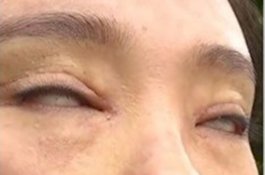 Wanita ini Habiskan Rp26 Juta untuk Operasi Plastik, Malah Jadi Cacat