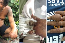 Pakai Cincin Bertahun-tahun, Jari-jari Pria Ini Diamputasi