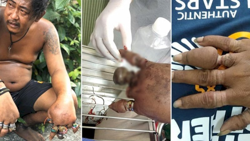 Dalam serangkaian foto viral yang diposting di Facebook, seorang pria paruh baya dari Thailand, terlihat dengan tangan bengkak dan banyak cincin serta karet gelang di semua jarinya.