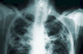 Ilmuwan Ciptakan Vaksin yang 50% Efektif Cegah TBC