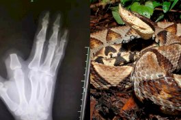 Petani Potong Jarinya Setelah Digigit Ular, Kemudian Diberitahu Itu Tidak Berbisa