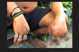 Lama Pakai Belasan Cincin, Jari Pria Ini Bengkak dan Membusuk