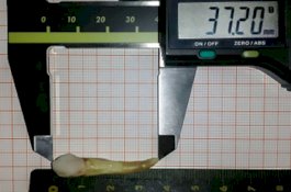 Dokter Kaget Cabut Gigi Pria Sepanjang 4 Cm