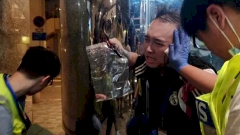 Andrew Chiu, tampak memegang telinganya yang nyaris terputus akibat digigit demonstran pro-Beijing. (Foto: Reuters)