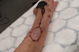 Gegara Dicakar Kucing, Nenek ini Koma dan Hampir Mati