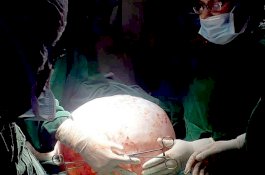 Dokter Angkat Tumor 18 Kg dari Perut Wanita yang Sulit Bernapas