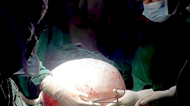 Dokter mengeluarkan tumor raksasa dari perut pasien