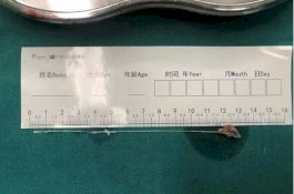 Cacing Pita Telah 'Memakan Otak' Pria ini Selama 15 Tahun