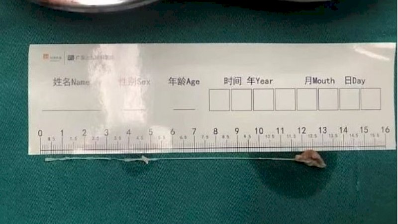 Cacing pita yang dikeluarkan dari kepala Wang