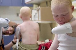 Dipercaya Bisa Datangkan Kekayaan, Bocah Albino Dipotong Tangannya saat Tidur