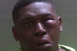 Culik Putri Petarung UFC, Mata Kiri Pria Ini Bengkak-bengkak