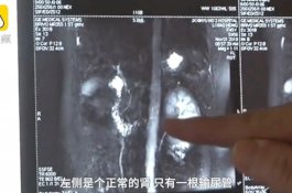 Punya Tiga Ginjal, Wanita ini Ingin Menyumbangkannya Satu