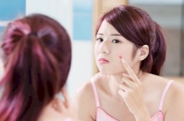 Jatuh Cinta Bikin Jerawatan, Benarkah?