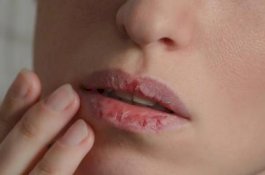 Begini Cara Alami Mengatasi Mulut Kering