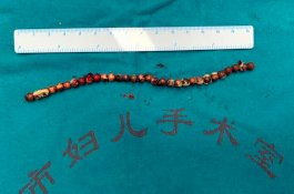 Mau Pelajari Anatomi Tubuh, Bocah Ini Masukkan 31 Bola Kecil ke Penisnya