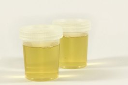 Di Atas Pesawat Dokter Selamatkan Nyawa Kakek dengan Mengisap Urine-nya