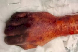 Berawal Dari Jilatan Anjing, Pria ini Sakit Parah Lalu Meninggal