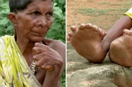 Lahir dengan 12 Jari Tangan dan 20 Jari Kaki, Wanita Ini Dicap Penyihir oleh Tetangga