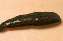 Terus-terusan Mimisan, Ternyata Ada Lintah di Hidung Pria Ini