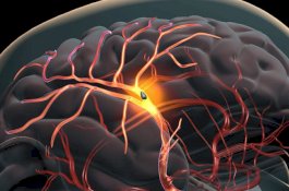 Bukan Penyakitnya, Pasien Kanker Lebih Banyak Meninggal akibat Stroke