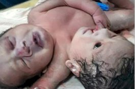 Lahirkan Bayi 2 Kepala dan 3 Tangan, Sang Ibu Pingsan