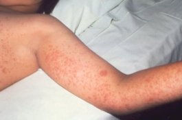 Wabah Campak di Samoa: Sudah 53 Orang Meninggal