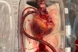 Dokter Berhasil Membuat Jantung Orang Mati Kembali Berdetak