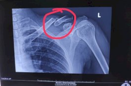 Selamat dari Tabrakan, Dosen STIBA Patah Tulang saat Menuju Masjid untuk Khotbah Jumat