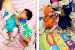 Ibu Terkejut Saat Melahirkan Bayi Kembar Beda: Satu Hitam, Satu Putih