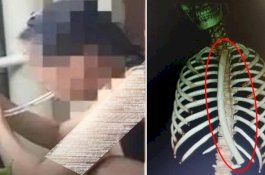 Ingin Kurus, Gadis 22 Tahun Ini Tak Sengaja Telan Selang 30 Sentimeter