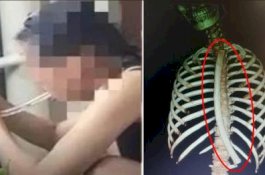 Berniat Langsing, Perempuan Ini Tak Sengaja Telan Selang 30 Cm