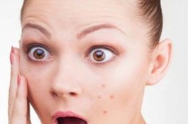 Cegah Jerawat dengan Makan Makanan Ini