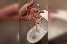 Cacing Pita 10 Meter Keluar dari Pantat Pria Ini Saat BAB