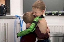 Bikin Haru, Dapat Lengan Palsu Laiknya 'Superhero', Bocah Ini Langsung Peluk Adiknya