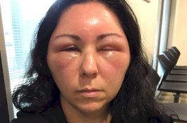 Warnai Rambut, Wanita Ini Derita Alergi Buat Wajahnya Bengkak