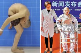 28 Tahun Hidup Membungkuk, Pria Ini Kini Bisa Berdiri Tegak Lagi