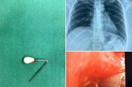 Dokter di Singapura: Semalam Tim Mengeluarkan Peniti dari Paruparu, Ngeri!