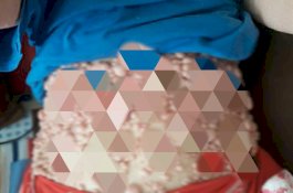 Seluruh Tubuh Wanita Ini Dipenuhi Ribuan Benjolan Kecil