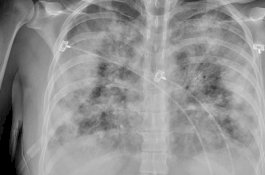 Andai Pneumonia 'Misterius' China Masuk Indonesia, Ini Langkah Kemenkes
