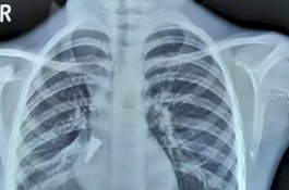 Gadis Ini Batuk Tiga Pekan Tanpa Henti, Dokter Temukan Penutup Pulpen di Paru-parunya