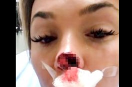 Bertengkar, Pria Ini Makan Hidung Pacarnya