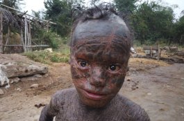 Bocah 10 Tahun Jadi Manusia Ular, Ganti Kulit Setiap Bulan