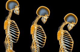 Osteoporosis Ternyata Dipengaruhi Gaya Hidup, Ini Hasil Penelitian Terbaru