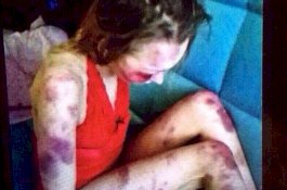 Usai Pukuli Istri Sampai Babak Belur, Suami Perlihatkan Fotonya ke Teman untuk Pamer