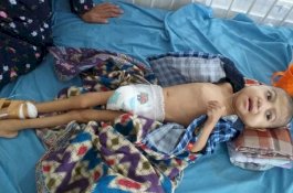 2 Anak Terkena Gizi Buruk, Ini Penjelasan Kepala Dinas Kesehatan Takalar