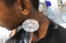 Tertusuk Ikan Sori di Leher, Siswa SMP Buton 14 Jam Menunggu Dioperasi